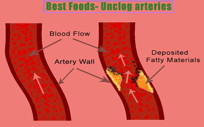 Best Foods That Unclog Arteries