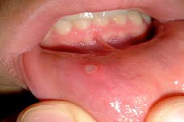 Becosules Mouth Ulcers
